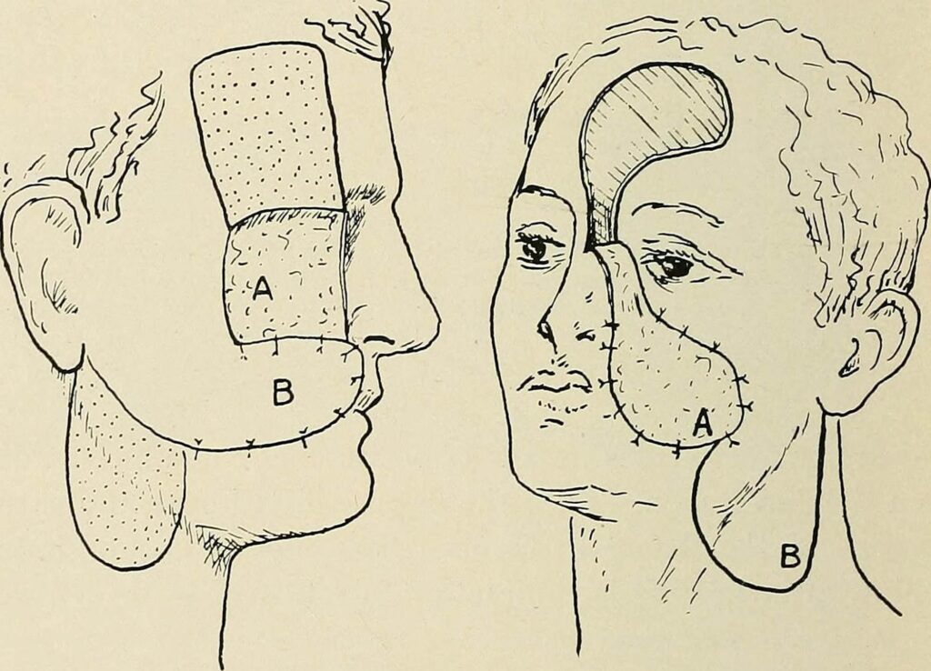 Surgical Death-Mask and the Post-Modern Canon